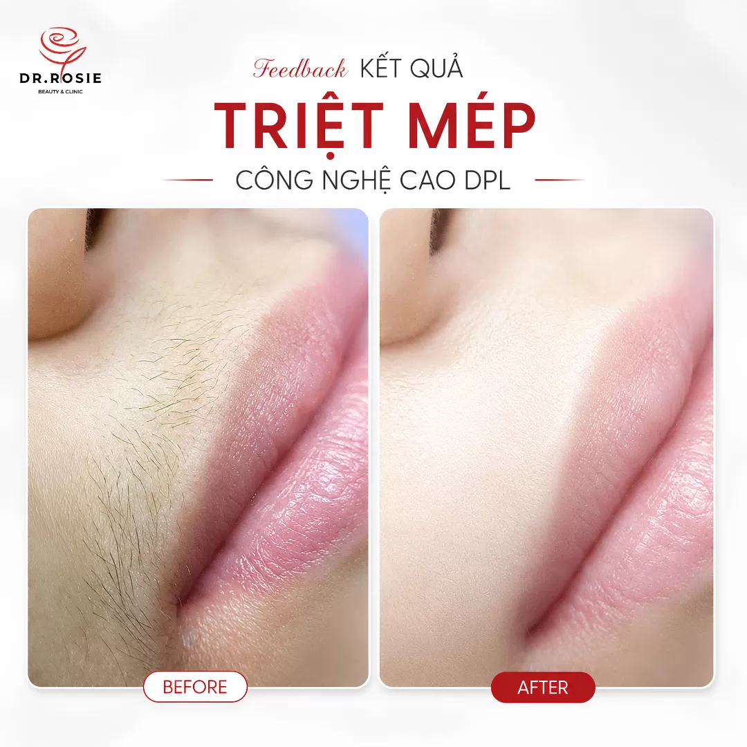 Triệt mép