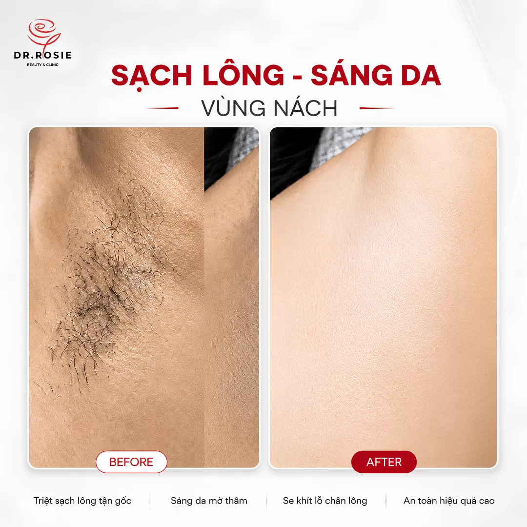 Triệt nách