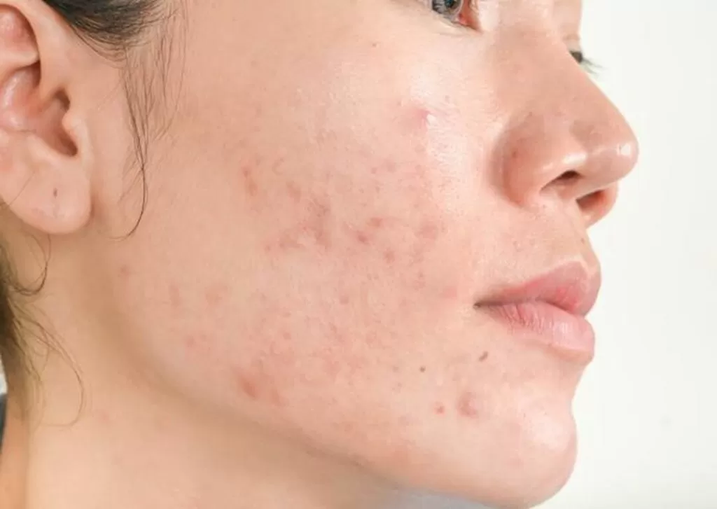 Điều trị mụn