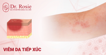 Viêm da tiếp xúc